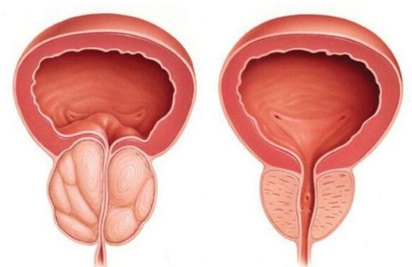 próstata normal e agrandada con prostatite